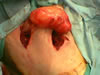 Giant Sciatic Nerve Tumor