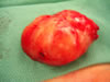 Giant Brachial Plexus Nerve Tumor 