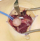 Neurofibromatosis, this is a schwannoma tumor.