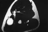 Picture showing a NMR of the arm with the tumor afecting cubital nerve.